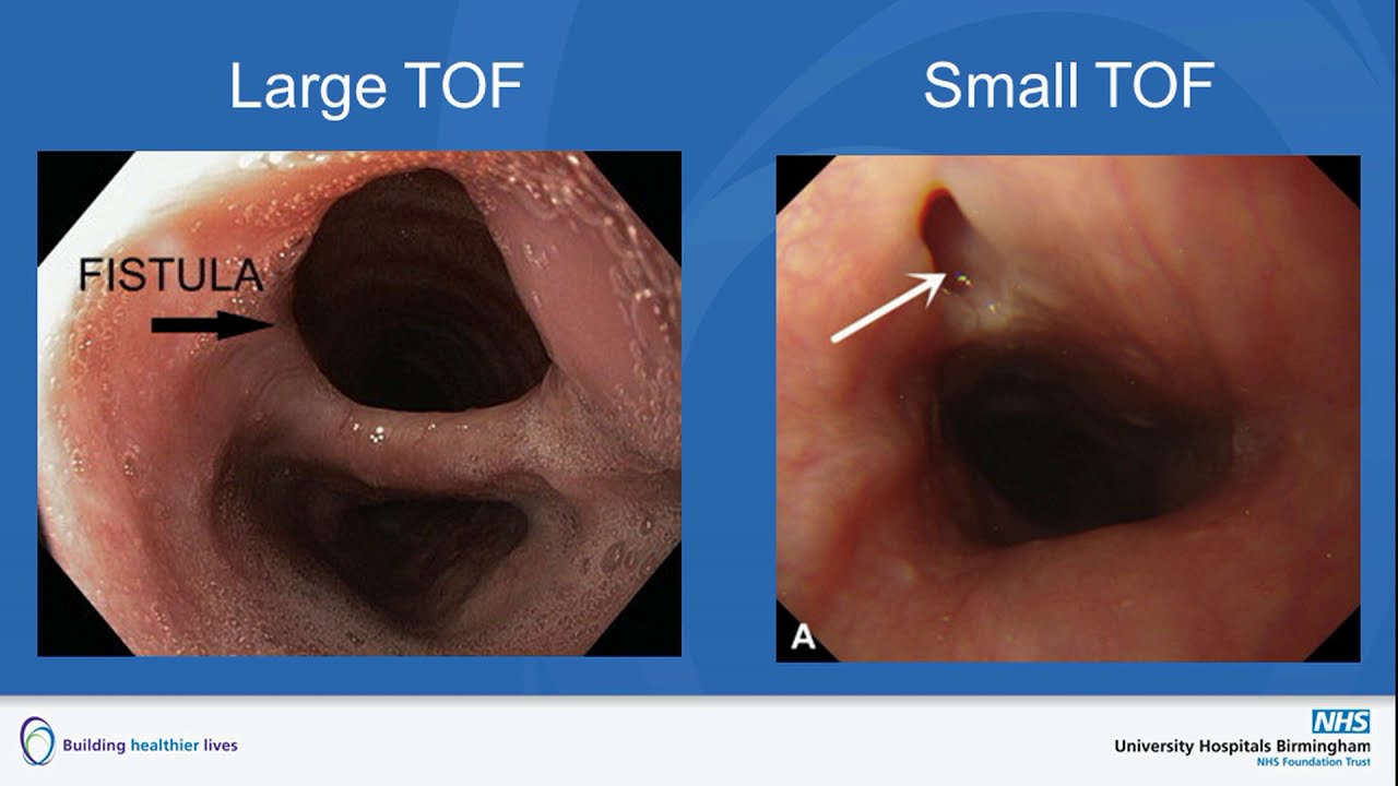 Treatments for GI Problems Experienced by OA/TOF Adults