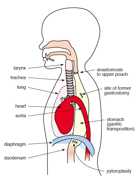 gastric transposition surgery