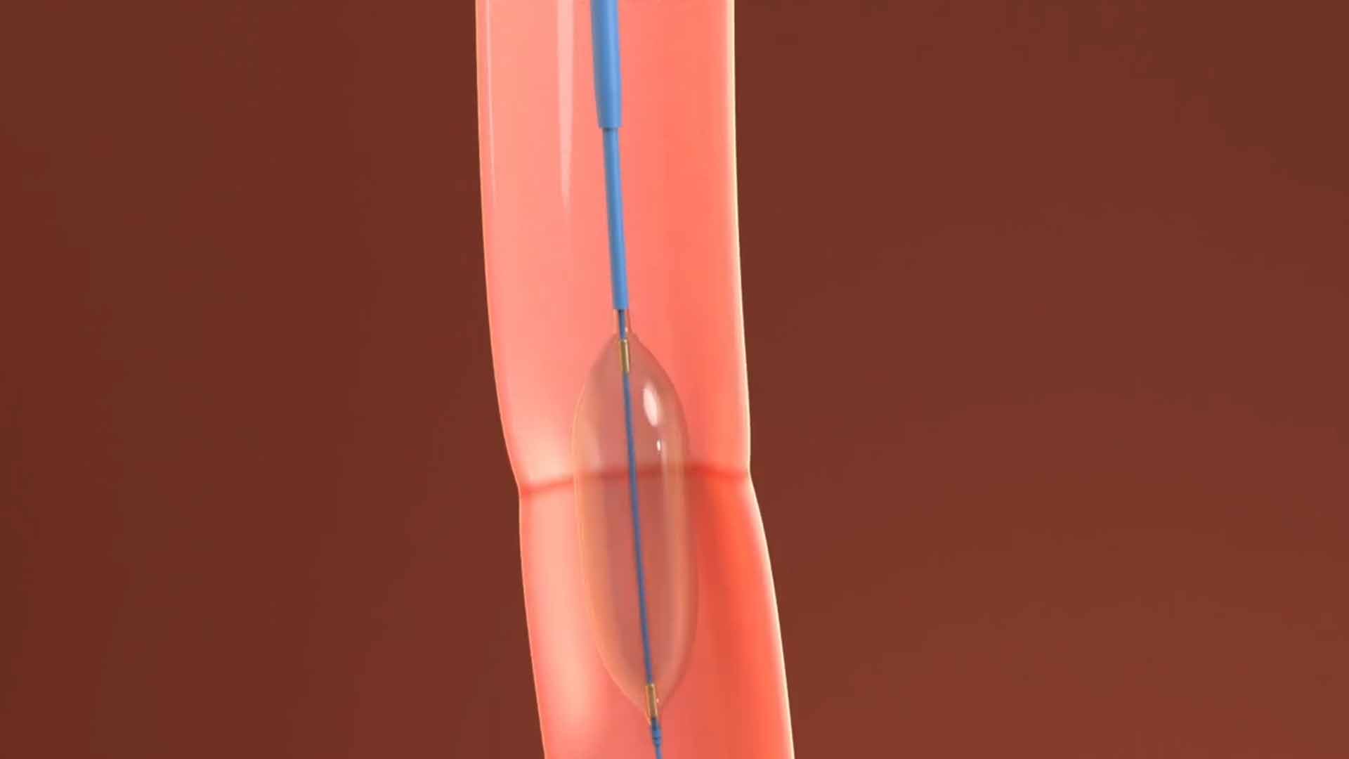 Oesophageal Dilation or children born with OA