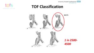 Long-term GI Complications